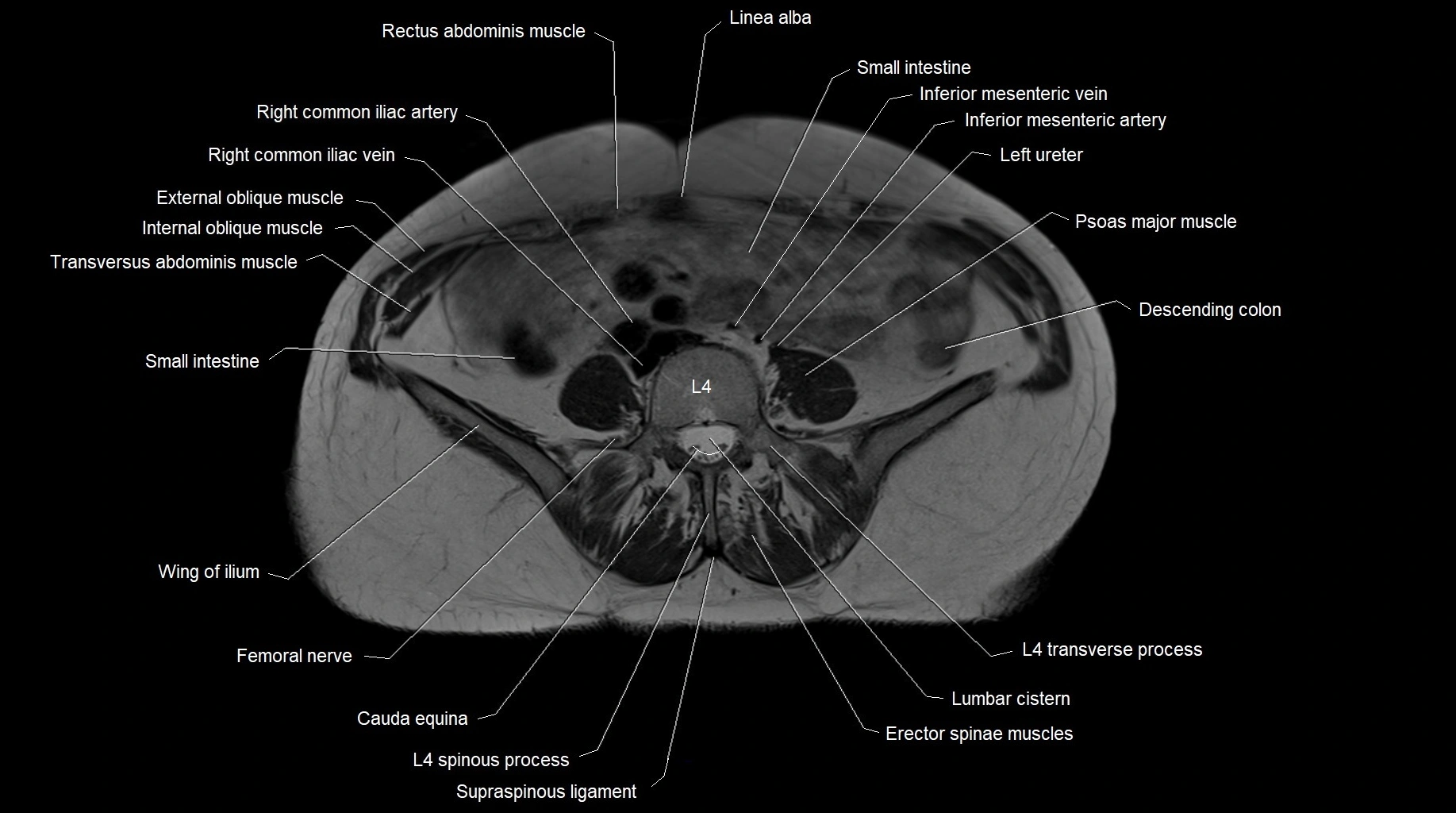 MRI 3T pelvis axial cross section anatomy image 1.webp